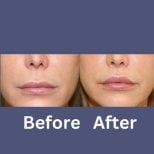 Before and after lip lift results at ID Clinic Bangkok, enhanced upper lip contour