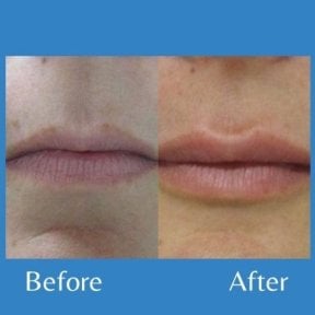 Before and after lip lift results at ID Clinic Bangkok, enhanced lip contour and shape