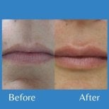Before and after lip lift results at ID Clinic Bangkok, enhanced lip contour and shape
