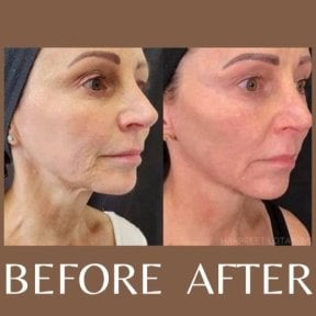 Before and after laser skin resurfacing results at ID Clinic Bangkok, smoother facial skin