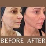 Before and after laser skin resurfacing results at ID Clinic Bangkok, smoother facial skin