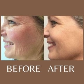 Before and after laser skin resurfacing at ID Clinic Bangkok, reduced wrinkles and smoother skin