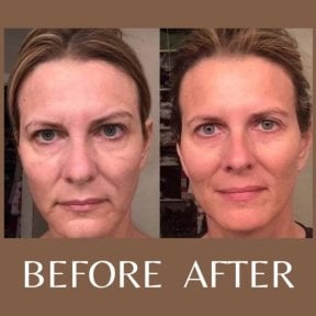 Before and after laser skin resurfacing results at ID Clinic Bangkok, facial rejuvenation