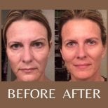 Before and after laser skin resurfacing results at ID Clinic Bangkok, facial rejuvenation