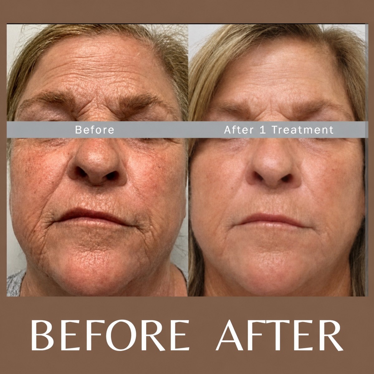 Resultados de rejuvenecimiento facial con láser en ID Clinic Bangkok antes y después