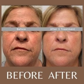 Before and after laser skin resurfacing at ID Clinic Bangkok, facial rejuvenation results