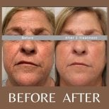 Before and after laser skin resurfacing at ID Clinic Bangkok, facial rejuvenation results