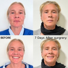Before and after deep plane facelift results at ID Clinic Bangkok, visible facial rejuvenation