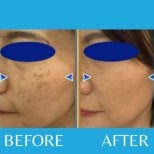 Before and after acne scar treatment results at ID Clinic Bangkok, smoother facial skin