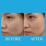 Before and after acne scar treatment results at ID Clinic Bangkok, smoother facial skin