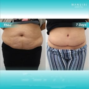 Before and after tummy tuck results at Wansiri Hospital, visible abdominal contour improvement