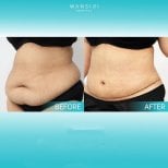 Before and after tummy tuck results at Wansiri Hospital, visible abdominal contour improvement