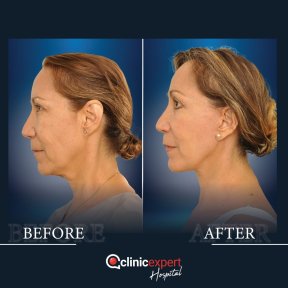 Facelift before and after results at CE International Hospital – visible facial rejuvenation