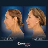 Facelift before and after results at CE International Hospital – visible facial rejuvenation