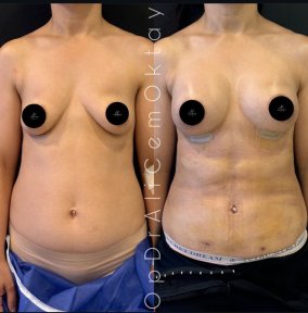 Vorher-nachher-Bauchdeckenstraffung bei Adem and Havva Medical Center, flacherer Bauch