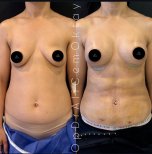 Vorher-nachher-Bauchdeckenstraffung bei Adem and Havva Medical Center, flacherer Bauch