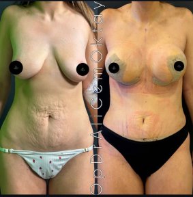 Vorher-nachher-Ergebnisse Bauchdeckenstraffung und Brustlifting bei Adem and Havva Medical Center