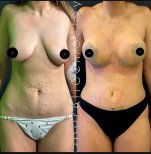 Vorher-nachher-Ergebnisse Bauchdeckenstraffung und Brustlifting bei Adem and Havva Medical Center