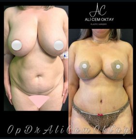 Vorher-nachher-Ergebnisse Bauchdeckenstraffung und Bruststraffung bei Adem and Havva Medical Center