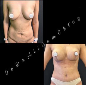 Vorher-nachher-Ergebnis Bauchdeckenstraffung bei Adem and Havva Medical Center, flacher Bauch