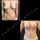 Vorher-nachher-Ergebnis Bauchdeckenstraffung bei Adem and Havva Medical Center, flacher Bauch