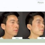 Before and after biostimulation facial treatment results at Plenary Wellness clinic