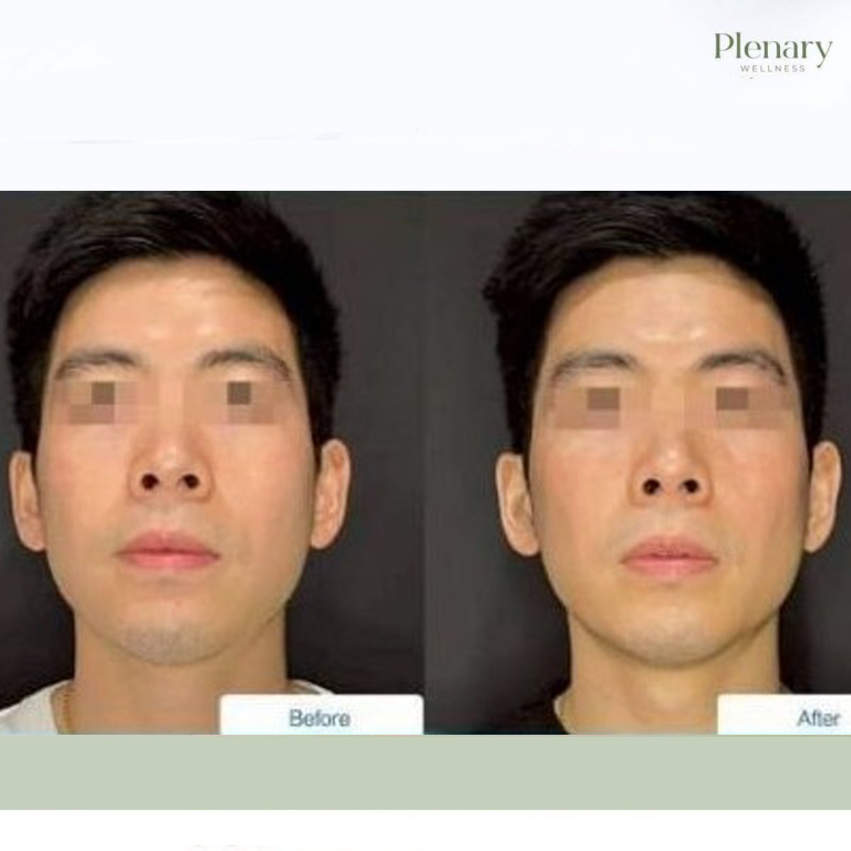 Resultados de biostimulación facial antes y después en Plenary Wellness
