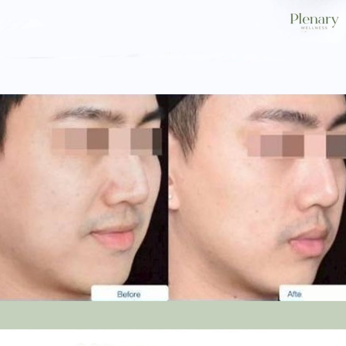 Resultados antes y después de biostimulación en Plenary Wellness, mejora de la piel facial