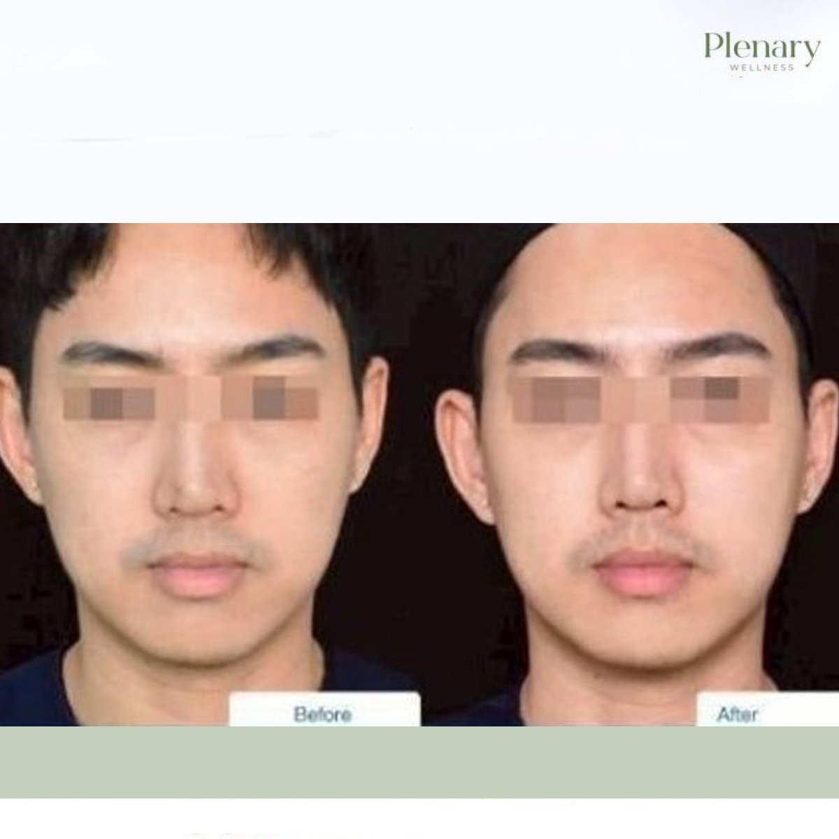 Resultados de rejuvenecimiento facial por biostimulación antes y después en Plenary Wellness