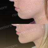 Vorher-nachher-Ergebnisse der Gesichtsfeminisierung im Memorial Bahçelievler Hospital, Kieferkontur