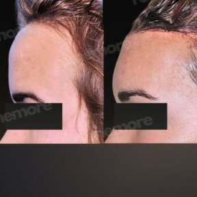 Vorher-nachher-Ergebnisse der Gesichtsfeminisierung im Memorial Bahçelievler Hospital