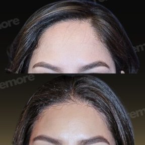 Vorher-nachher-Ergebnis der Gesichtsfeminisierung am Memorial Bahçelievler Hospital, Stirn