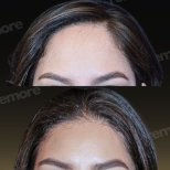 Vorher-nachher-Ergebnis der Gesichtsfeminisierung am Memorial Bahçelievler Hospital, Stirn