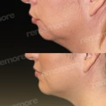 Vorher-nachher-Ergebnisse der Gesichtsfeminisierung im Memorial Bahçelievler Hospital