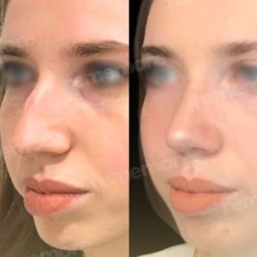 Vorher-nachher-Ergebnis der Gesichtsfeminisierung im Memorial Bahçelievler Hospital