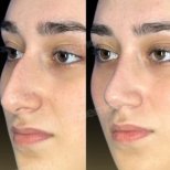 Vorher-nachher-Ergebnis der Gesichtsfeminisierung im Memorial Bahçelievler Hospital