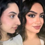 Vorher-nachher-Ergebnisse der Gesichtsfeminisierung im Memorial Bahçelievler Hospital