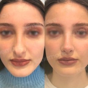 Vorher-nachher-Ergebnisse der Gesichtsfeminisierung im Memorial Bahçelievler Hospital