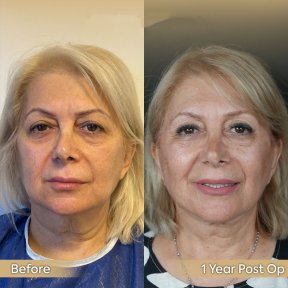 Brow Lift Vorher-Nachher-Ergebnis bei Dr. Safa Manav Clinic, sichtbare Verjüngung nach 1 Jahr