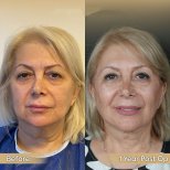 Brow Lift Vorher-Nachher-Ergebnis bei Dr. Safa Manav Clinic, sichtbare Verjüngung nach 1 Jahr