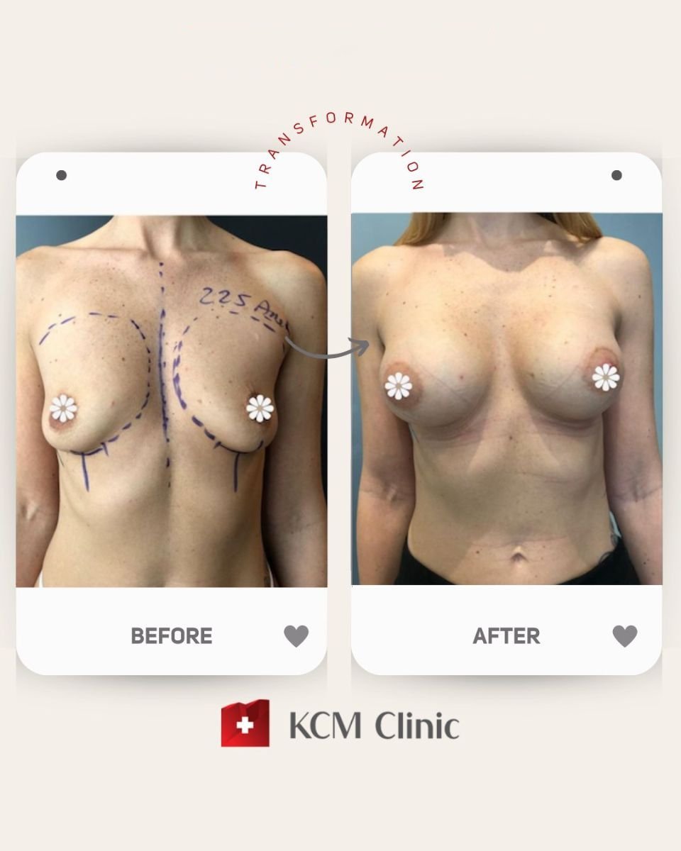 Before and after breast lift results at KCM Clinic, improved breast contour and symmetry