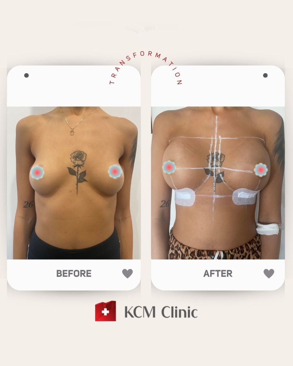 Before and after breast lift results at KCM Clinic – improved breast shape and contour