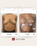نتائج شد الثدي قبل وبعد في عيادة KCM – تحسين شكل وتناسق الثدي