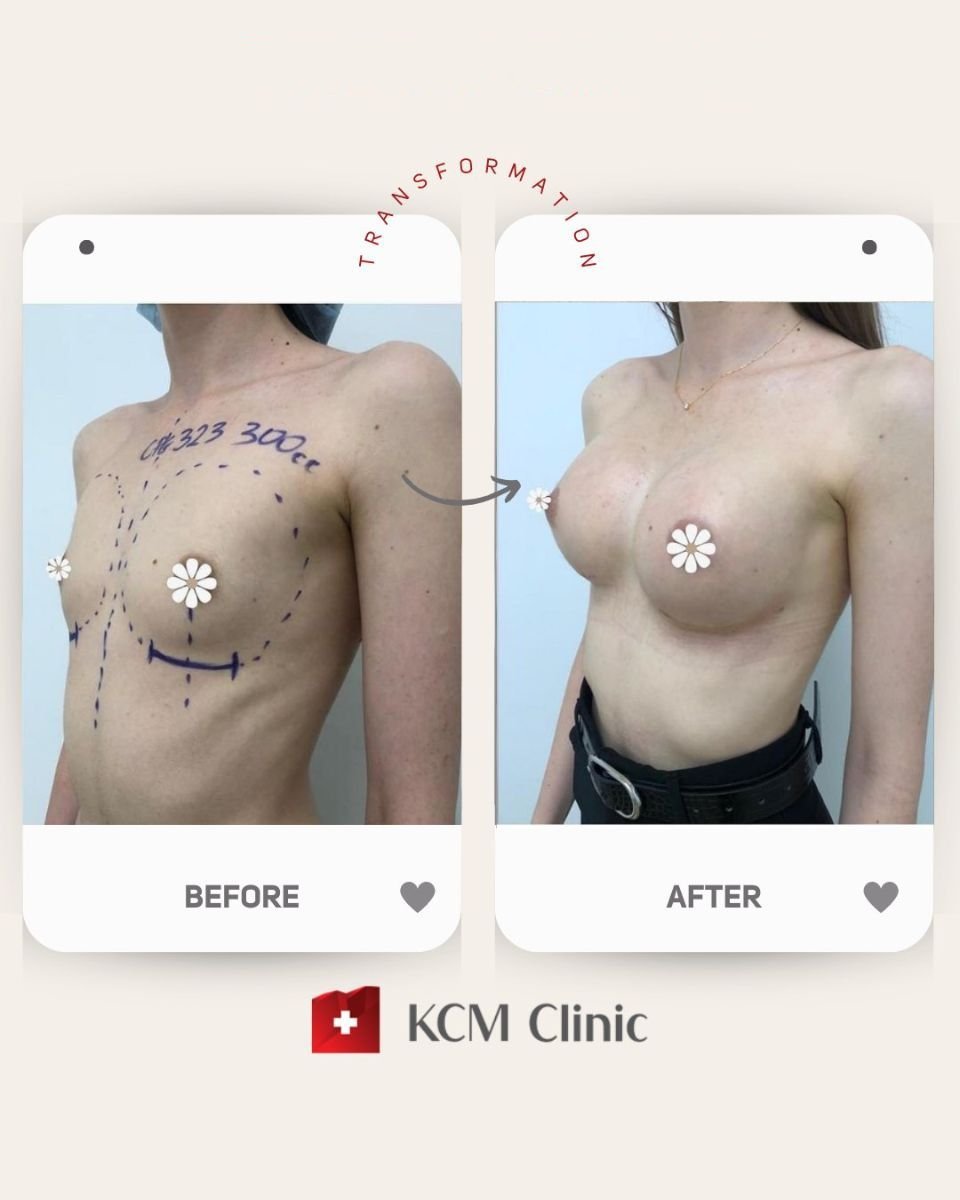 Before and after breast lift results at KCM Clinic, visible breast contour improvement