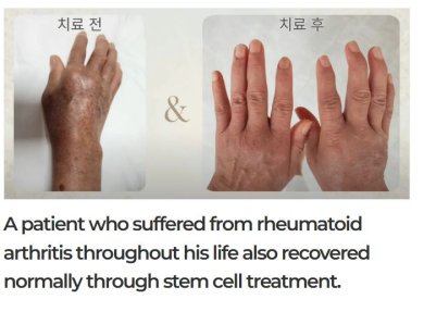 Before and after stem cell therapy for rheumatoid arthritis at RE:YOUTH clinic, hand results