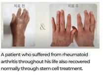 Before and after stem cell therapy for rheumatoid arthritis at RE:YOUTH clinic, hand results