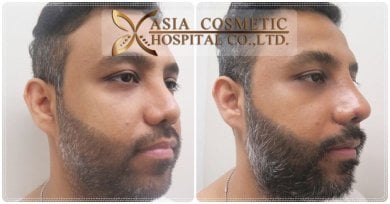 Before and after beard transplant results at Asia Cosmetic Hospital, fuller beard appearance