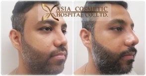 Before and after beard transplant results at Asia Cosmetic Hospital, fuller beard appearance