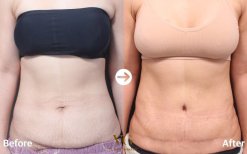 Vorher-nachher-Liposuktionsergebnis bei VG Plastic Surgery, sichtbare Bauchkontur-Verbesserung