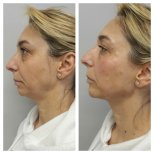 Before and after Botox injections at CE International Hospital, visible facial rejuvenation result